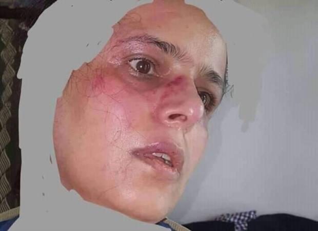 بعد وصفها لزعيم المتمردين بالمرأة الحامل والجبان : مليشيا الحوثي تعتدي بوحشية على الناشطة ابتسام ابو دنيا