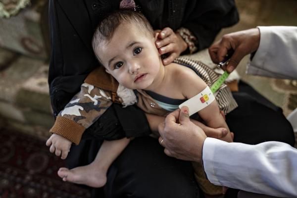 تحذيرات من إصابة 2.25 مليون طفل يمني بسوء التغذية الحاد
