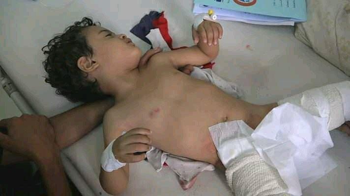 إصابة امرأة وطفلة برصاص قناصة الميلشيا جنوبي الحديدة